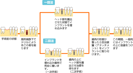 インプラント手術