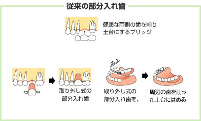 従来の部分入れ歯