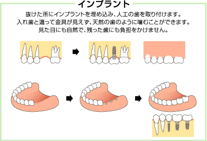 インプラント