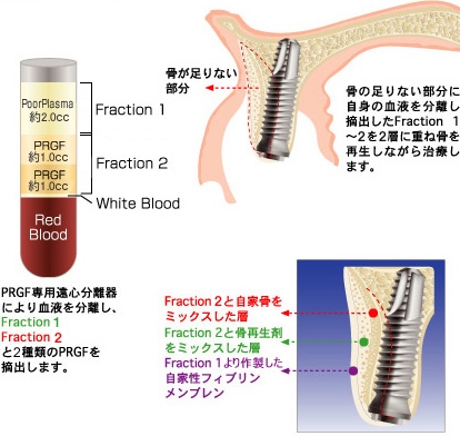 PRGF治療システム