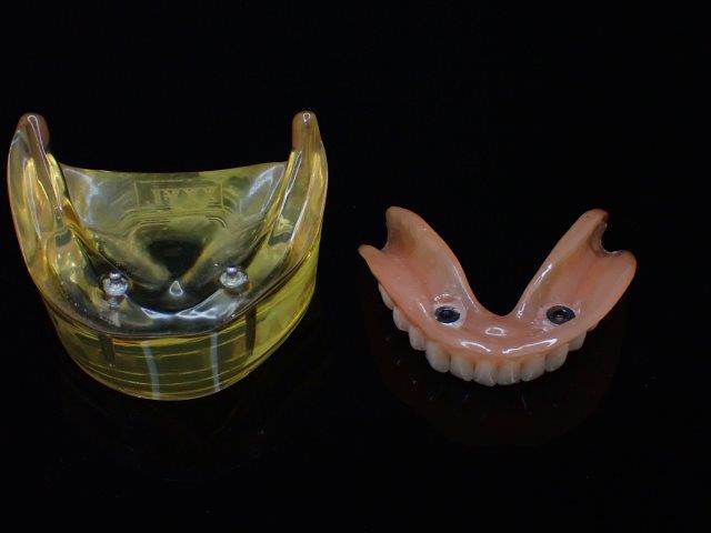 インプラント人工歯